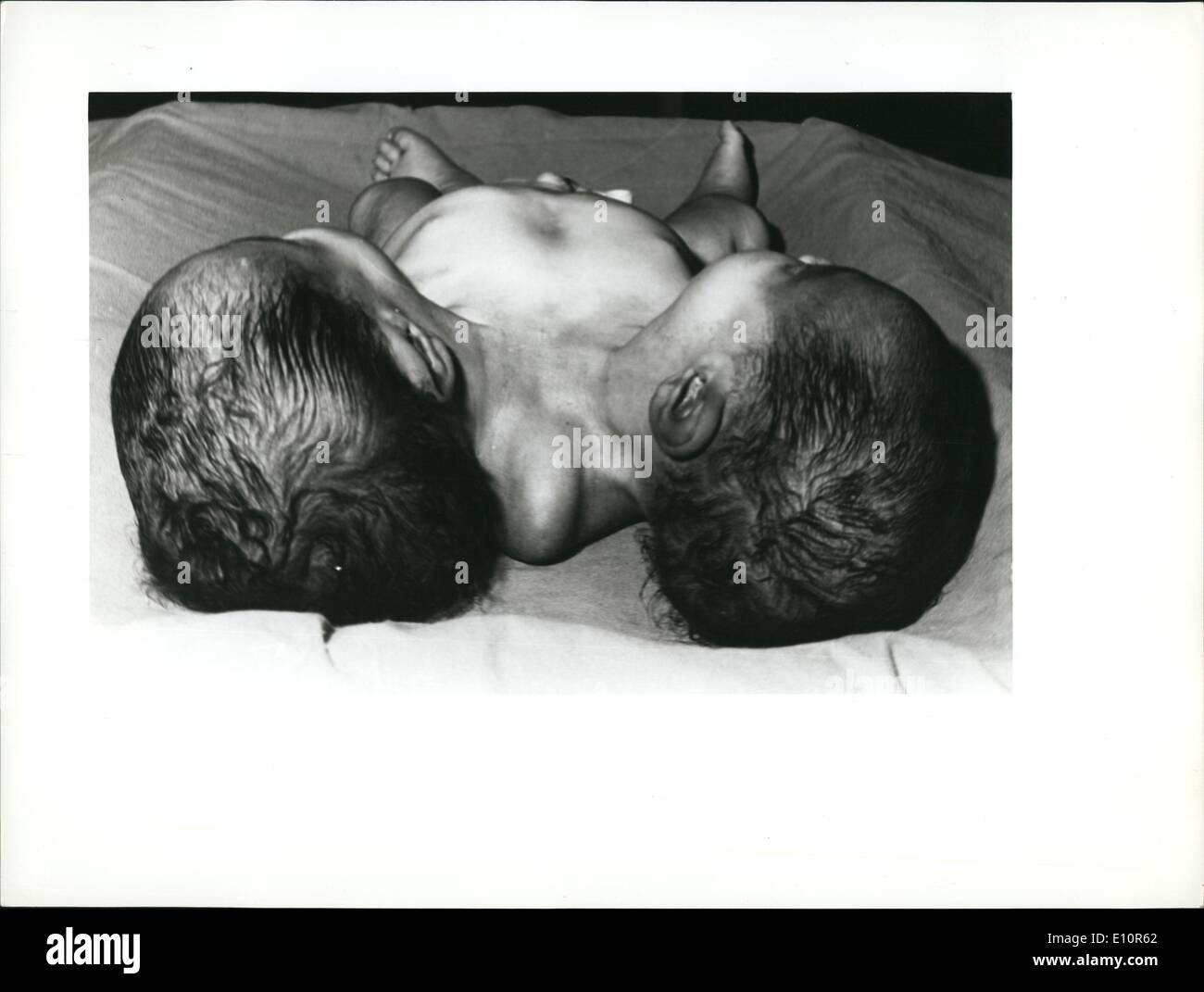 Oct. 10, 1973 - Double headed still from feature male can 5 kilos - after Ces operation '' Illegible Stock Photo