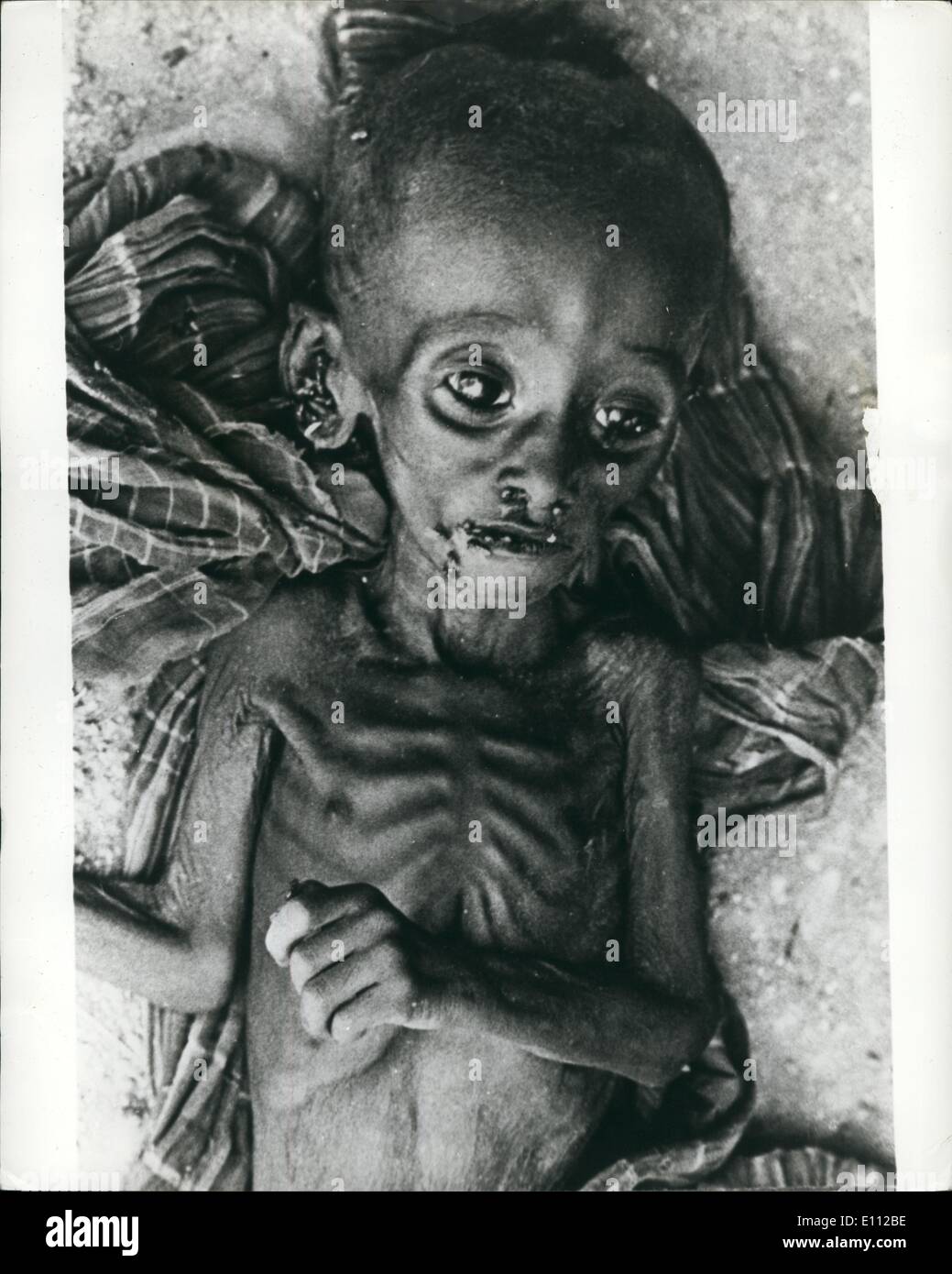 May 05, 1975 - Victim of famine: This picture, recently taken in Ethiopia by an Oxfam nurse, shows the spelling effects of the famine that has struck the nomadic people of the Ogaden desert region in the S.E. of the country. The famine has already claimed the lives of hundreds of children like this one, and over 40,000 people have crowded into relief camps that have been setup in remote desert villages. The photograph was taken by Stephanie symmonds when working at the intensive feeding unit she helped to run at Gode near the Somali border. Stock Photo