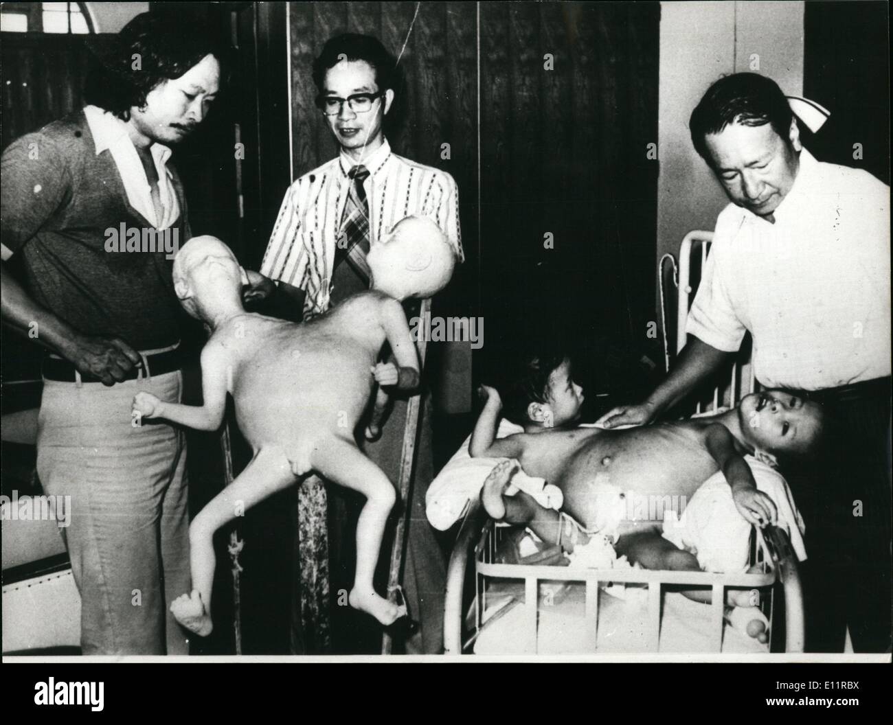 Oct. 10, 1979 - To 32-month old brothers, Chang Chung-Jen and Chang Chung-Yi, conjoined a the abdomen, were separated successfully at the National University Hospital in Taiwan after a 12 hour operation which required the attention of 36 doctors from all over the world. Stock Photo