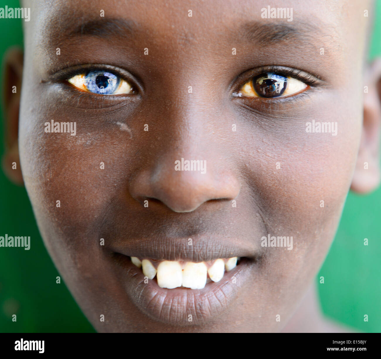 A Kenyan boy that has two different color eyes. this symptom is known as  Heterochromia of the eye. Stock Photo