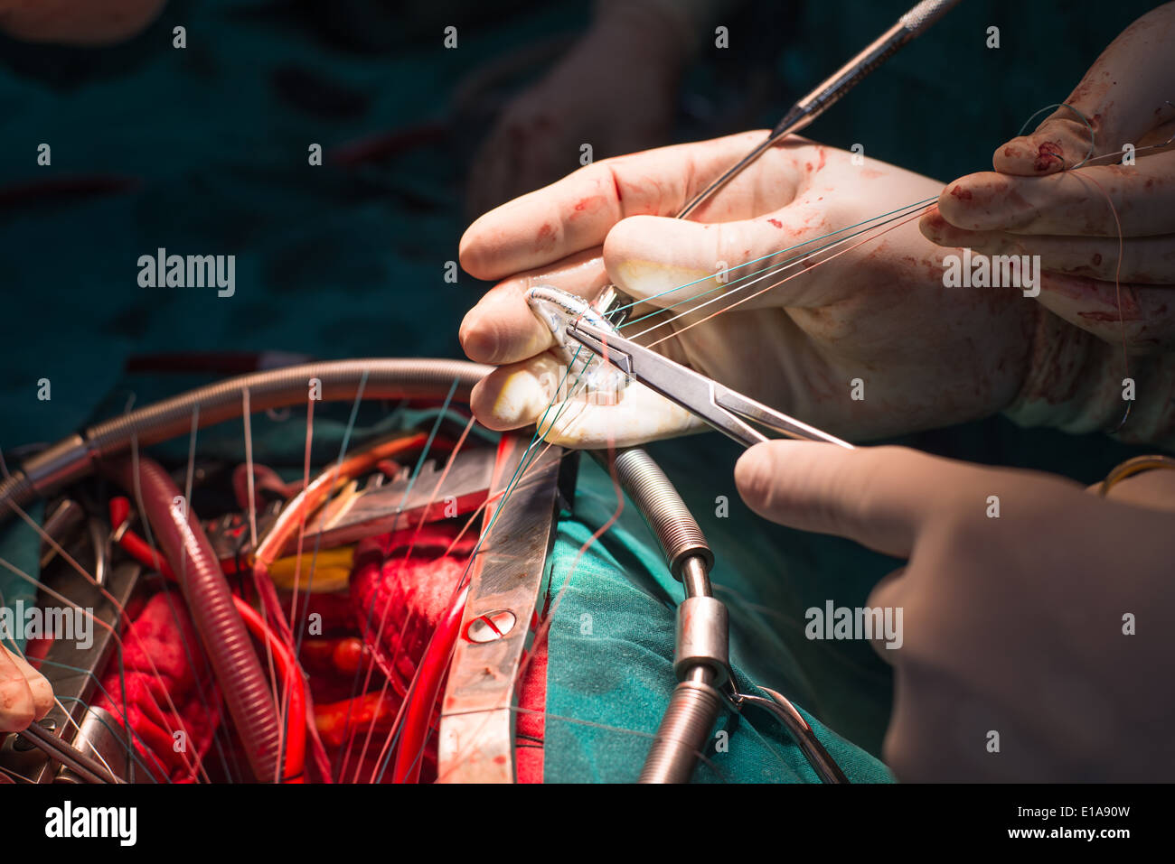 suture valve ring in mitral valve repair operation Stock Photo