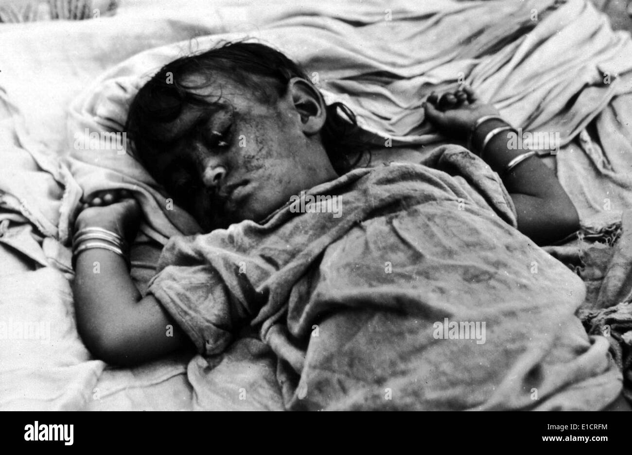 Trachoma. A young Indian girl with a Trachoma infection sleeps with flies around her eyes. WHO photo by Homer Page. ND Stock Photo