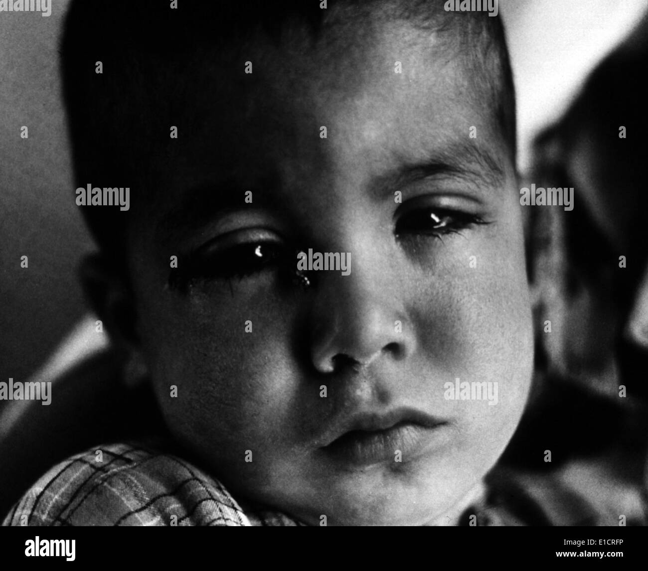 Trachoma. A young a young child with flies around his eyes. WHO photo by Homer Page. ND Stock Photo