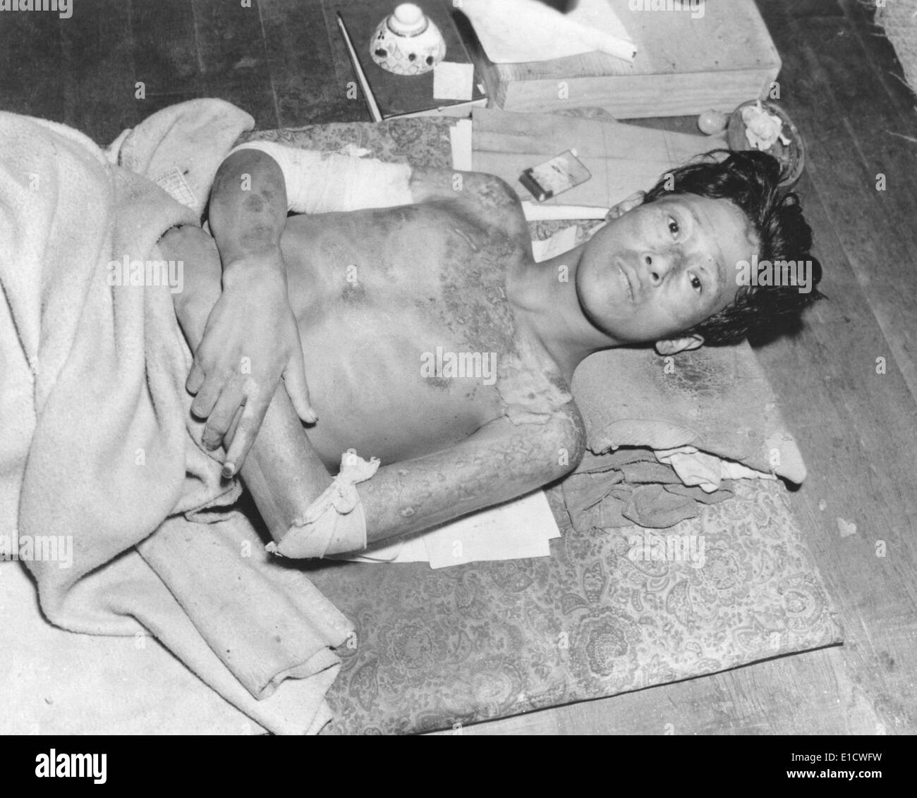 Japanese male victim of the atom bomb explosion over Nagasaki, Japan. Sept.-Dec. 1945. (BSLOC 2014 6 95) Stock Photo