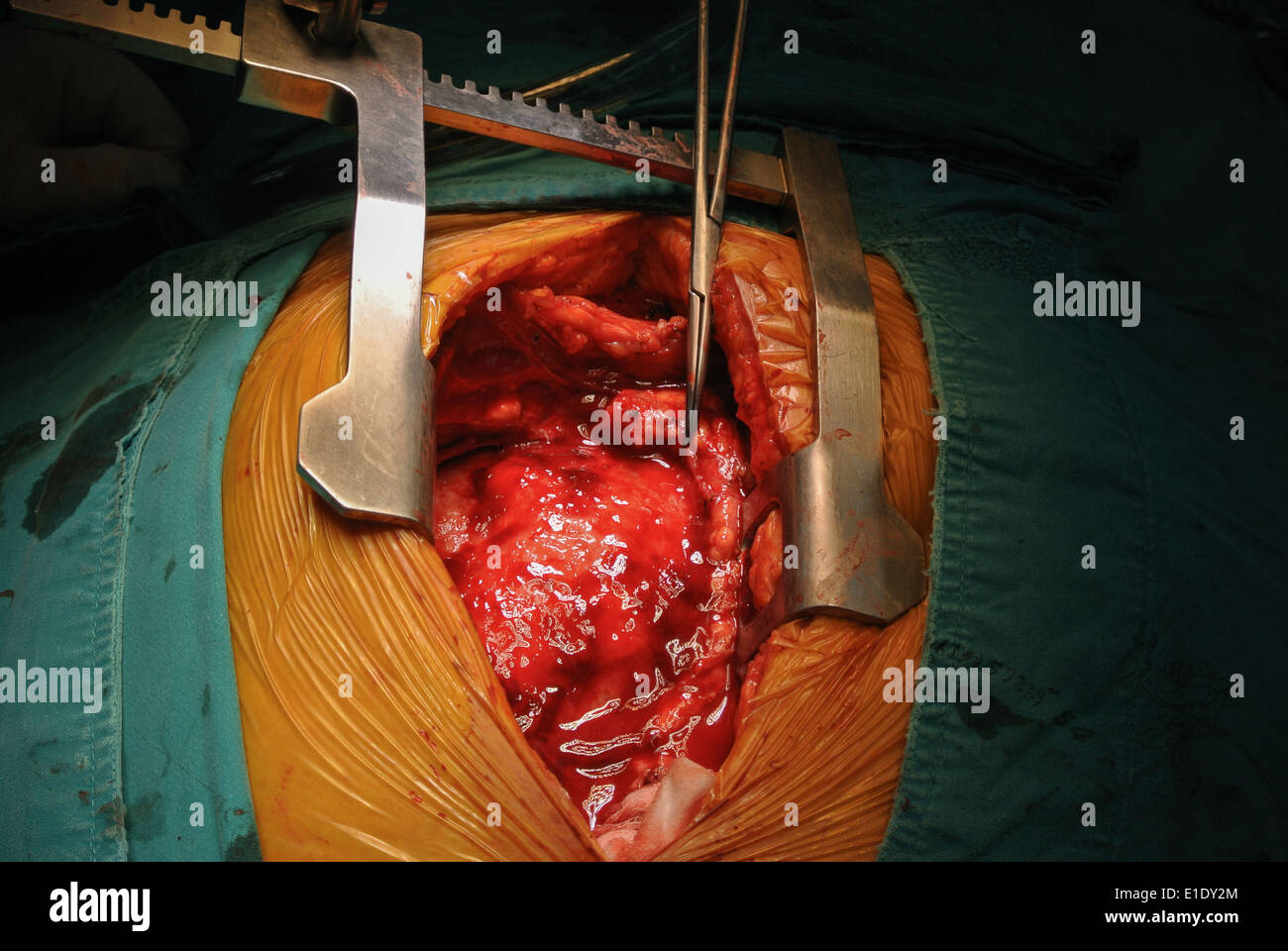 cardiac tumor Stock Photo
