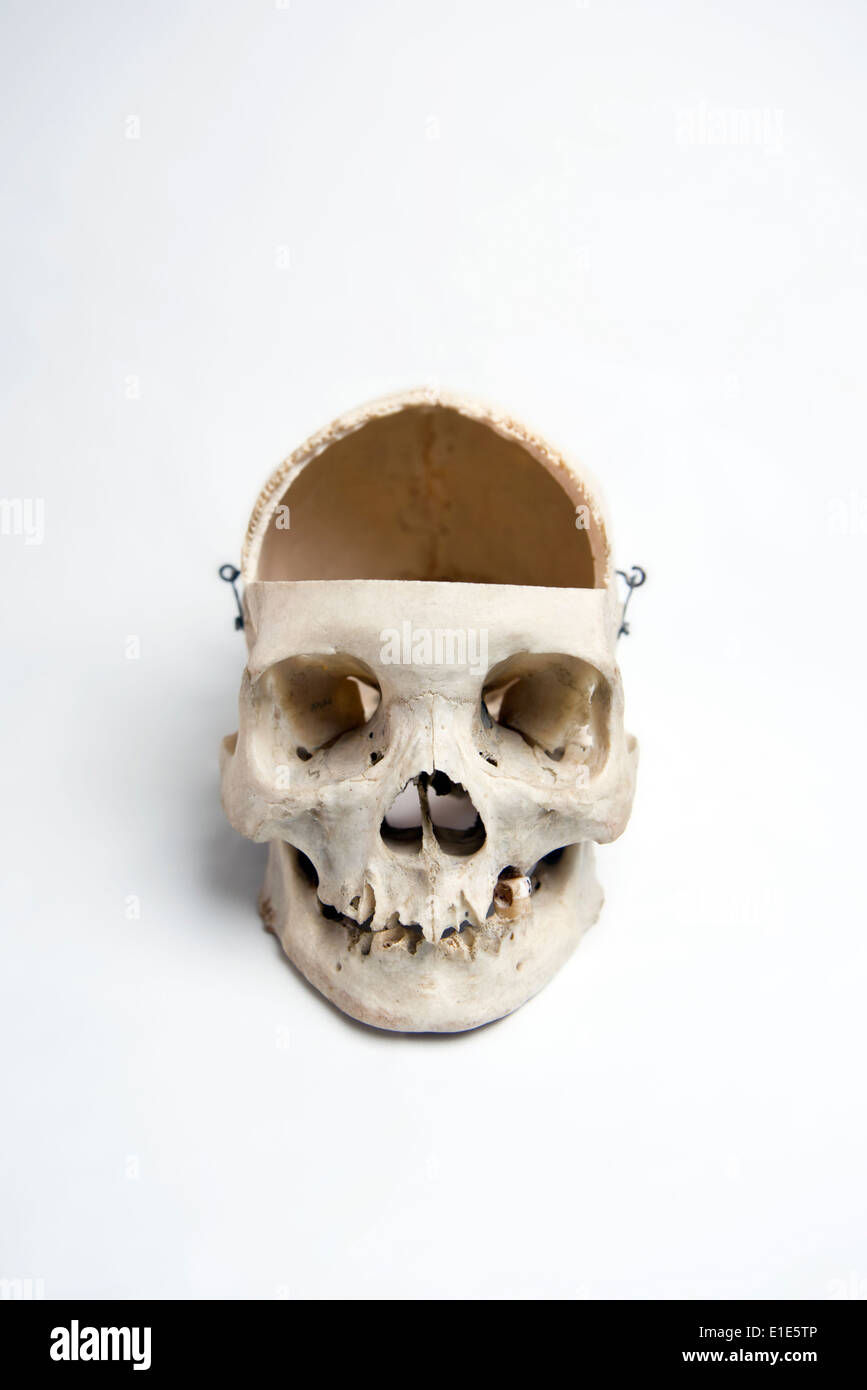 Genuine Human Skull with trephination and front quarter removed used for Medical Studies Stock Photo