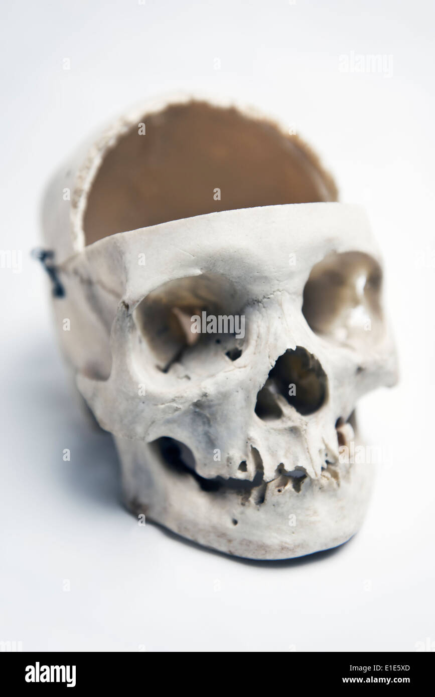 Genuine Human Skull with trephination and front quarter removed used for Medical Studies Stock Photo
