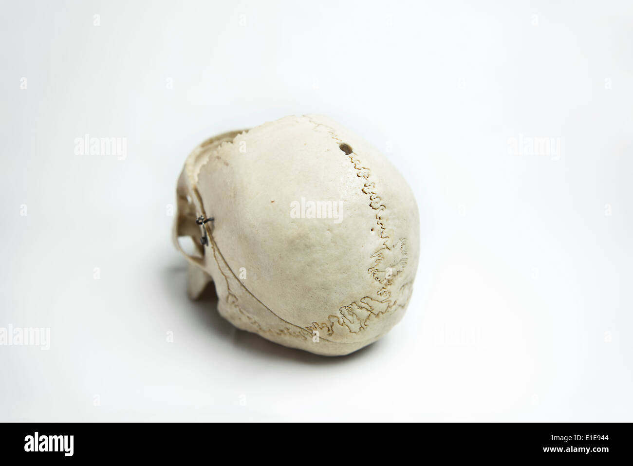 Genuine Human Skull with trepidation and front quarter removed used for Medical Studies Stock Photo