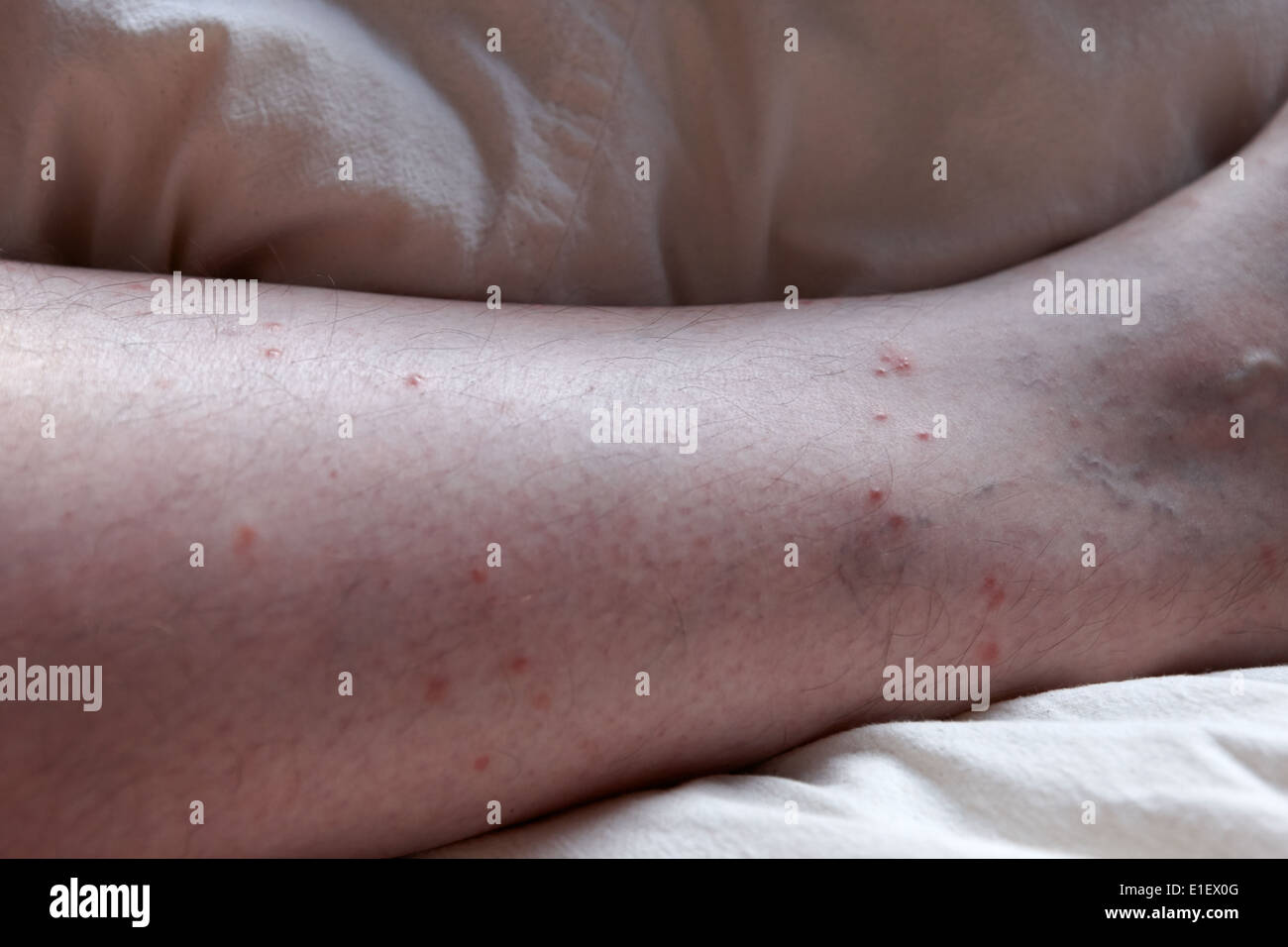 middle aged mans leg with flea and insect bite marks above sock line Stock Photo