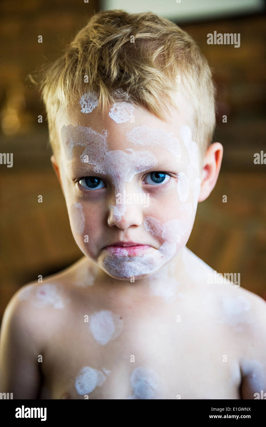 A five year old boy being treated with Calamine Lotion for chicken pox - Varicella zoster virus. Stock Photo