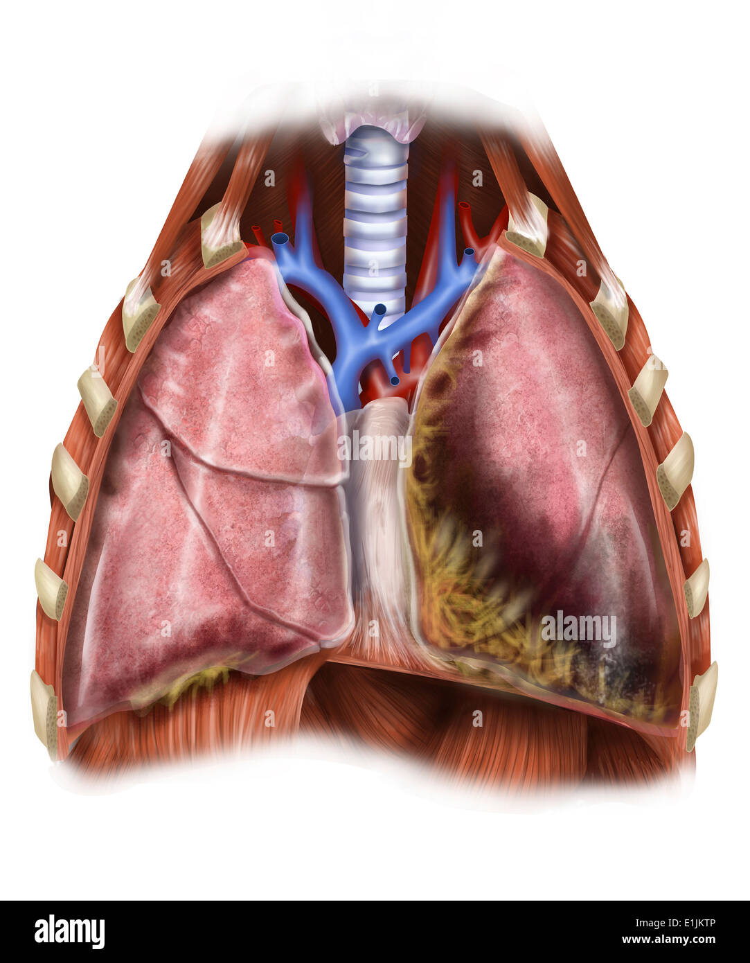 Artist depiction of mesothelioma in the lungs/abdominal cavity. Stock Photo