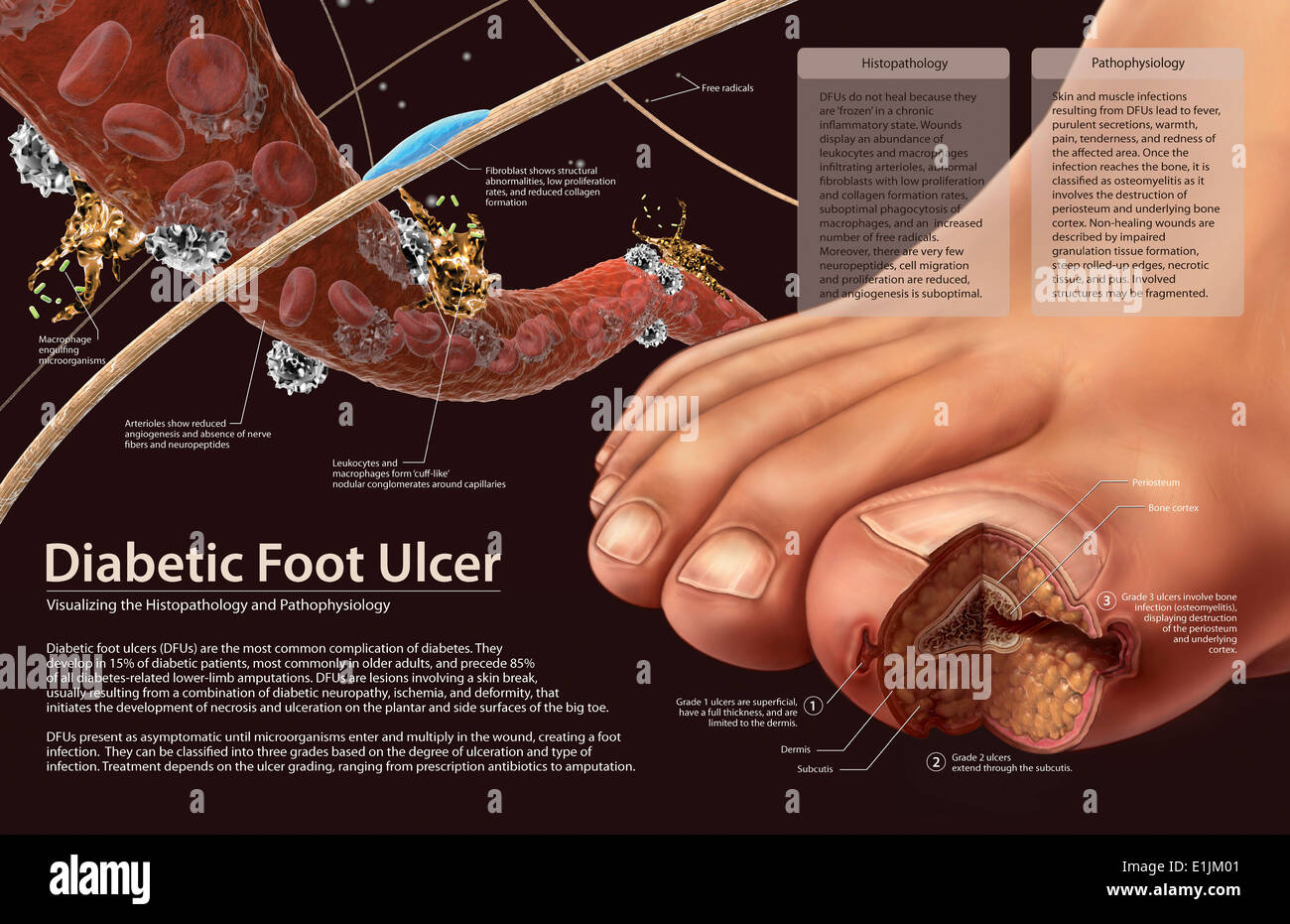 Histopathology and pathophysiology of diabetic food ulcers. Stock Photo