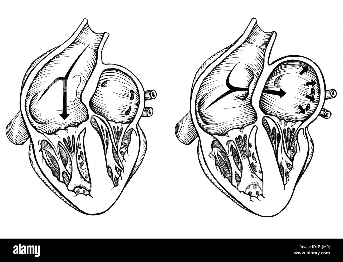 Comparison of normal heart versus heart with a patent foramen ovale. Stock Photo