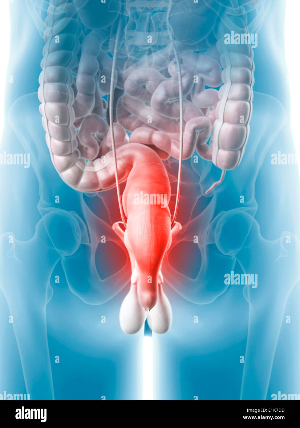 Inflamed rectum computer artwork. Stock Photo