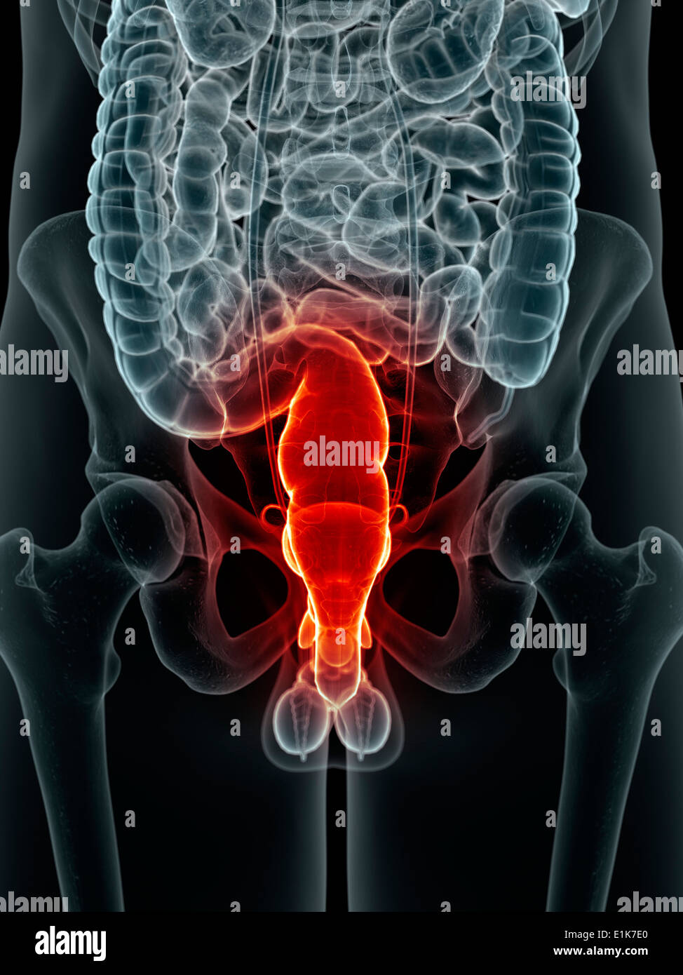 Inflamed rectum computer artwork. Stock Photo