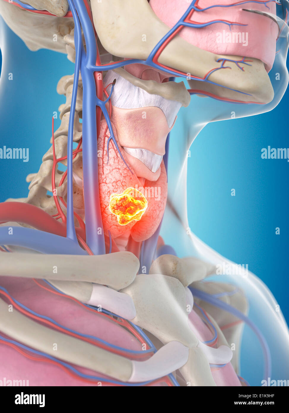 Human thyroid gland showing a tumor computer artwork Stock Photo - Alamy
