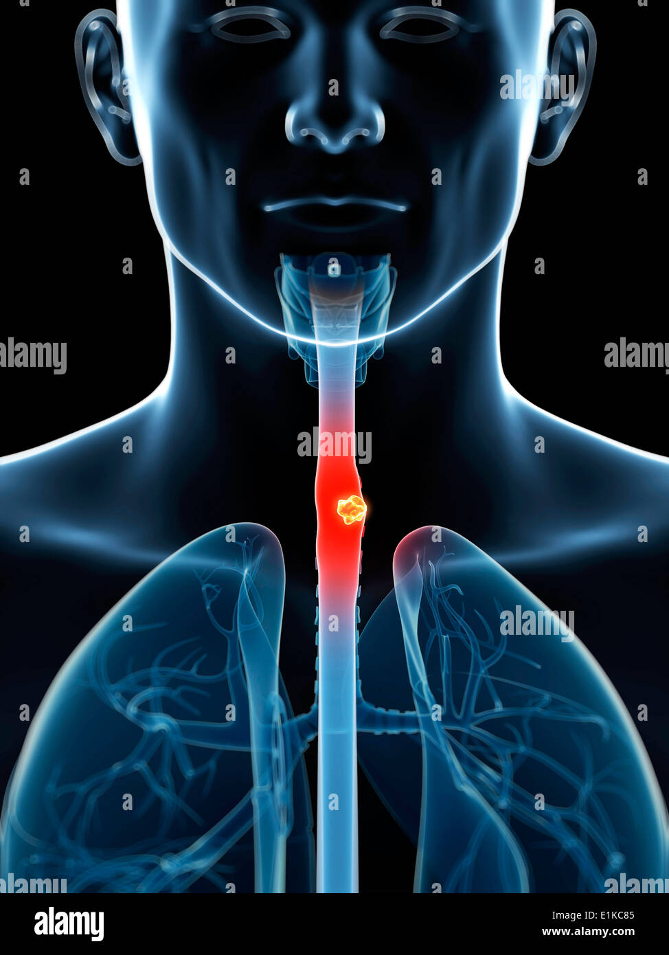 Human food pipe (oesophagus) with tumour computer artwork. Stock Photo