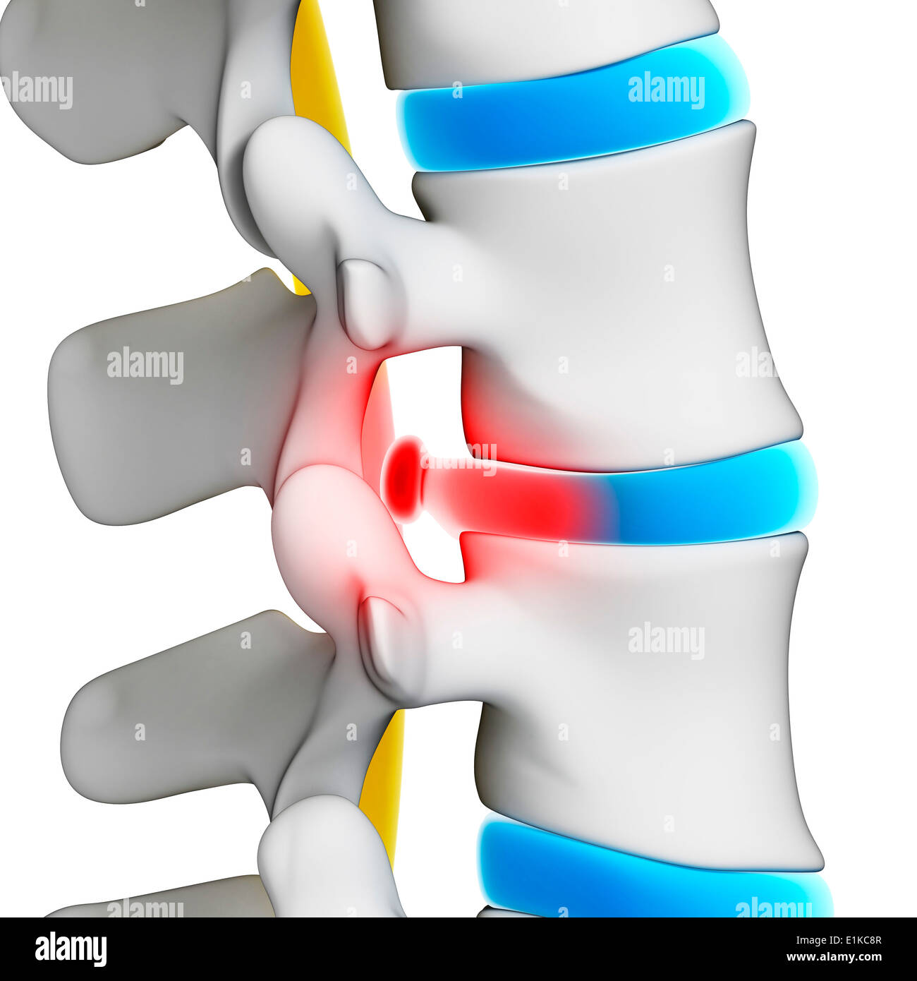 Human spinal disc herniation (slipped disc) computer artwork. Stock Photo