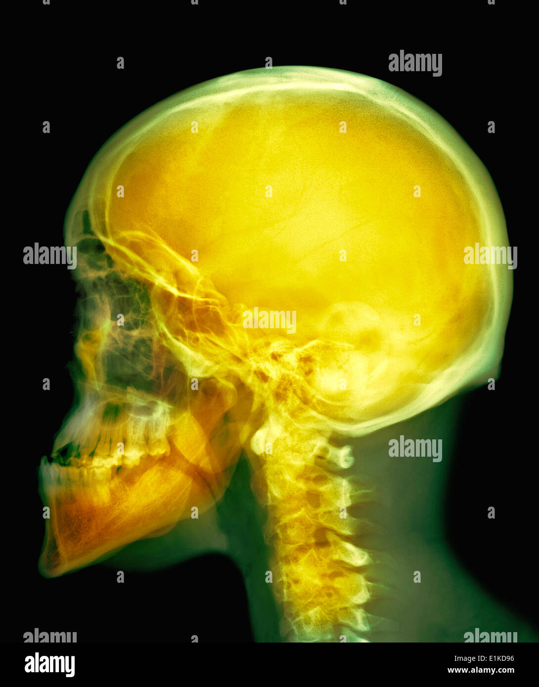 Skull Coloured X-ray of the skull of a 30 year old male. Stock Photo