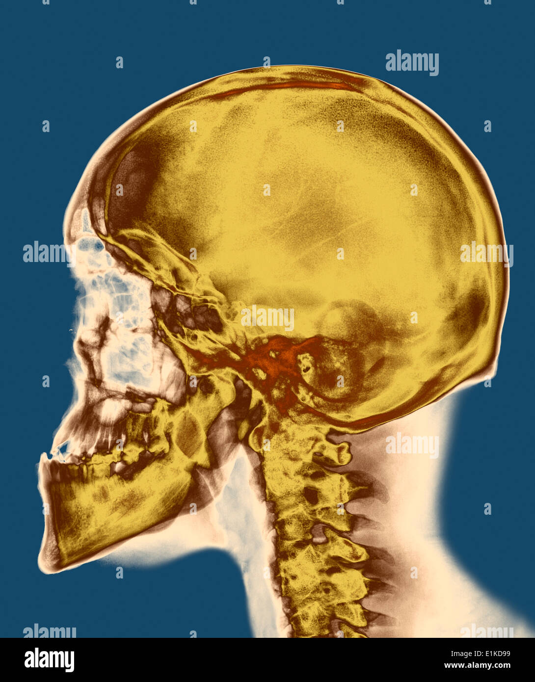 Skull Coloured X-ray of the skull of a 30 year old male. Stock Photo