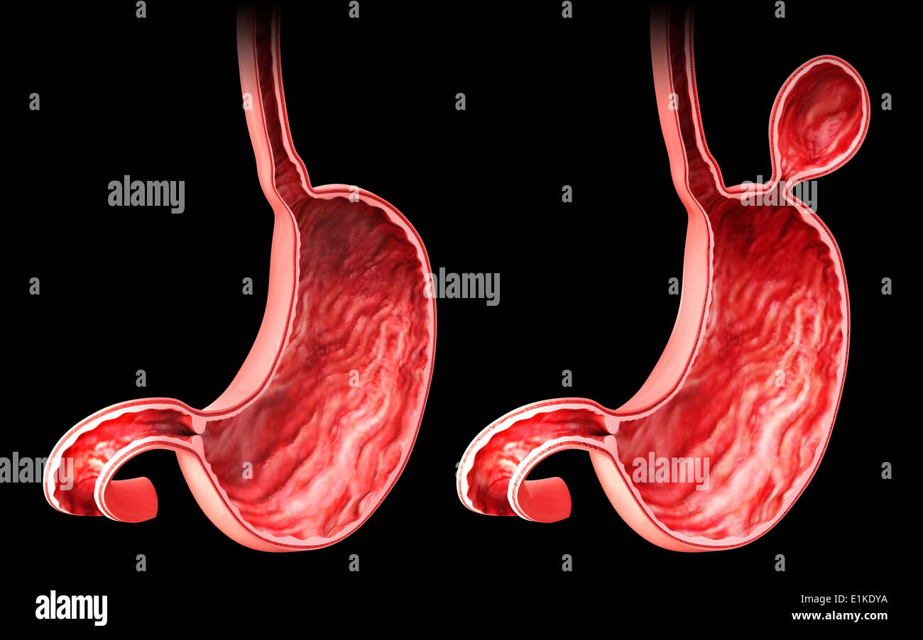 Human stomach with hernia cut-away computer artwork. Stock Photo