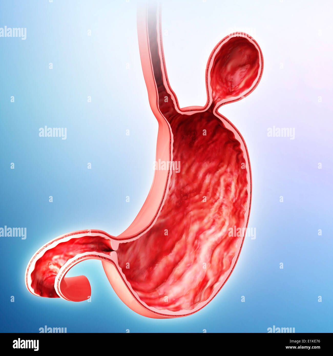 Human stomach with hernia cutaway computer artwork Stock Photo Alamy