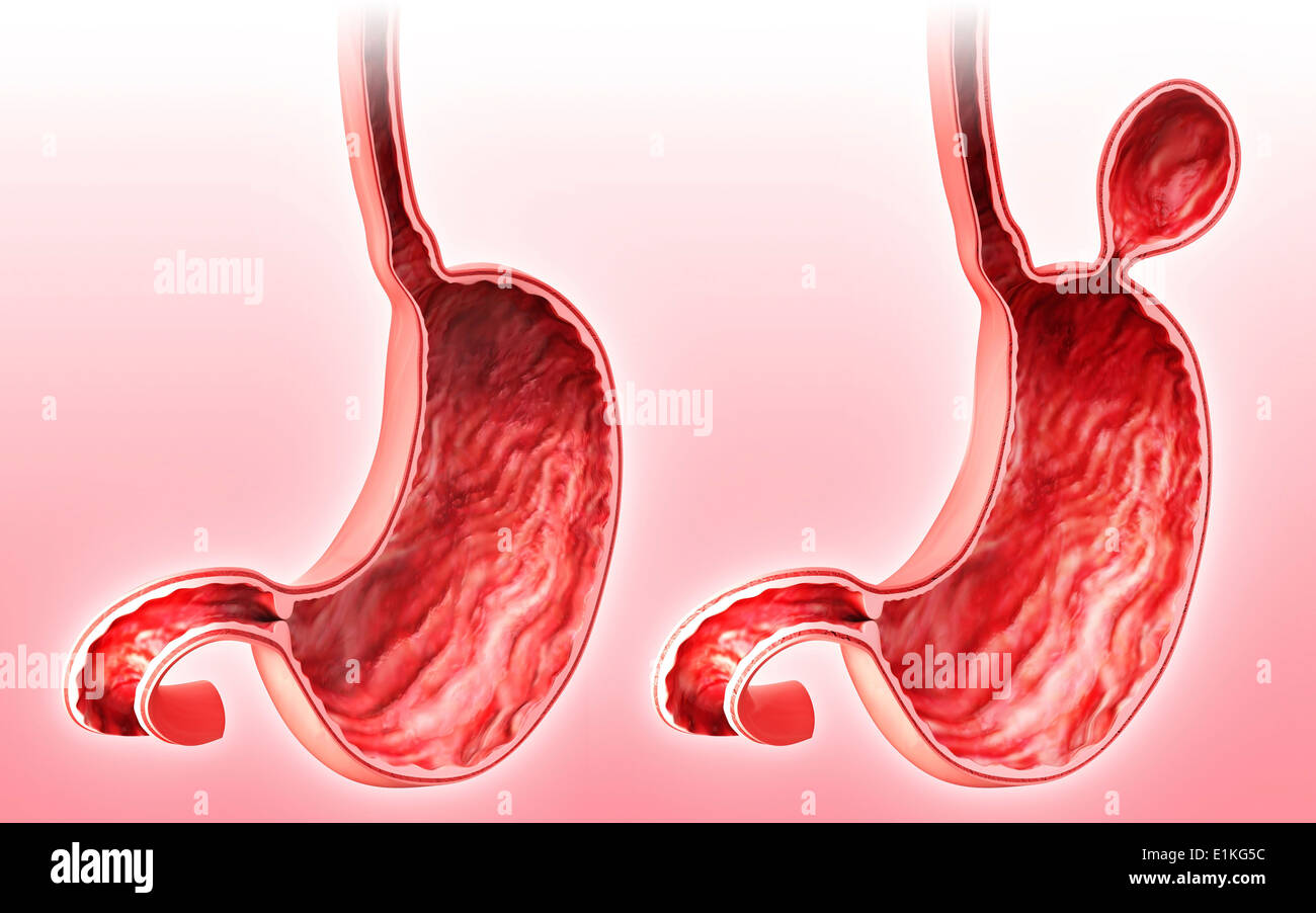 Hiatal hernia hires stock photography and images Alamy