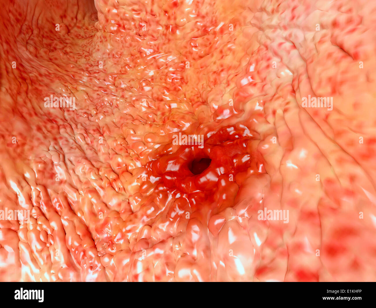 Artwork based on an endoscopic image of a stomach ulcer. Stock Photo