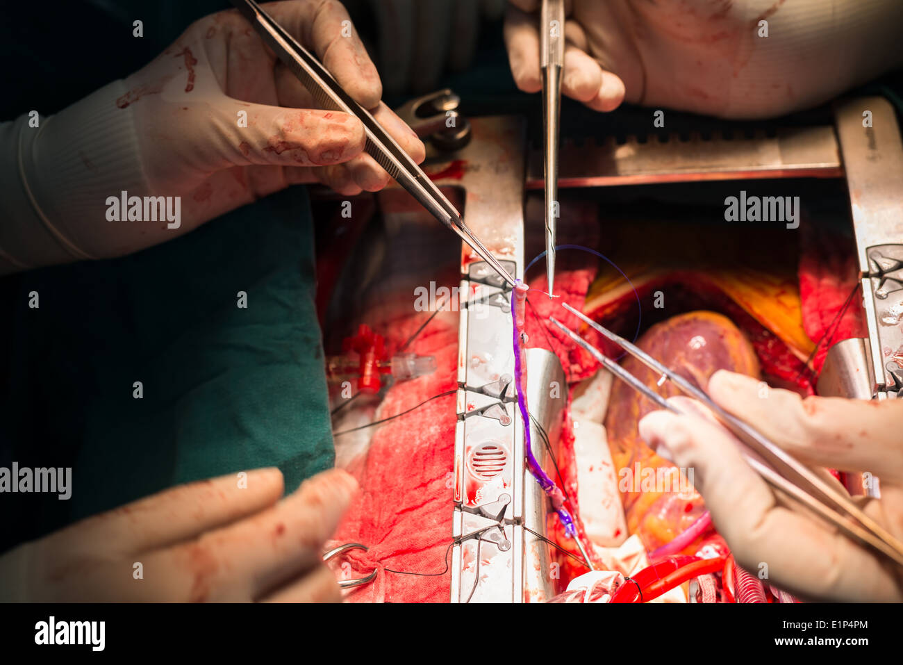 Coronary artery bypass grafting diagonal artery anastomosis Stock Photo