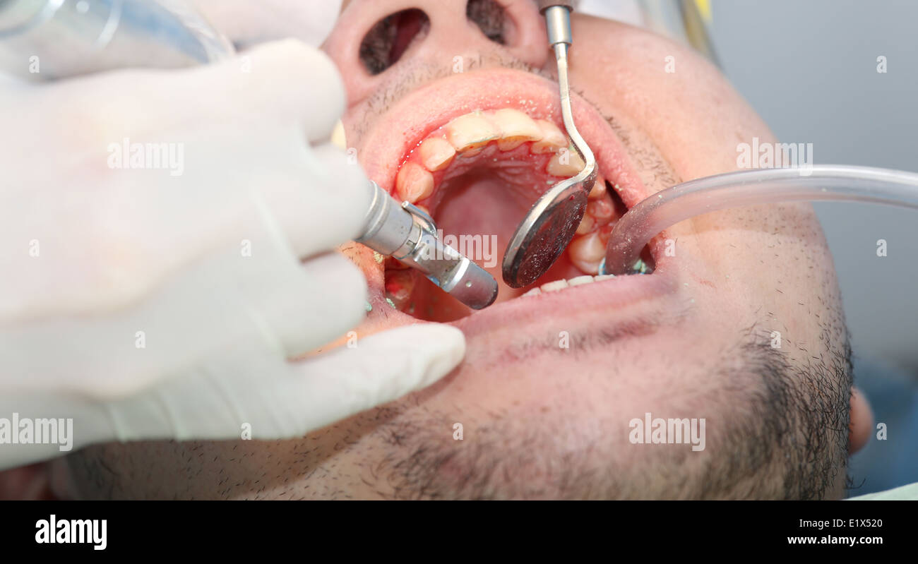mouth bleeding at the dentist office Stock Photo Alamy