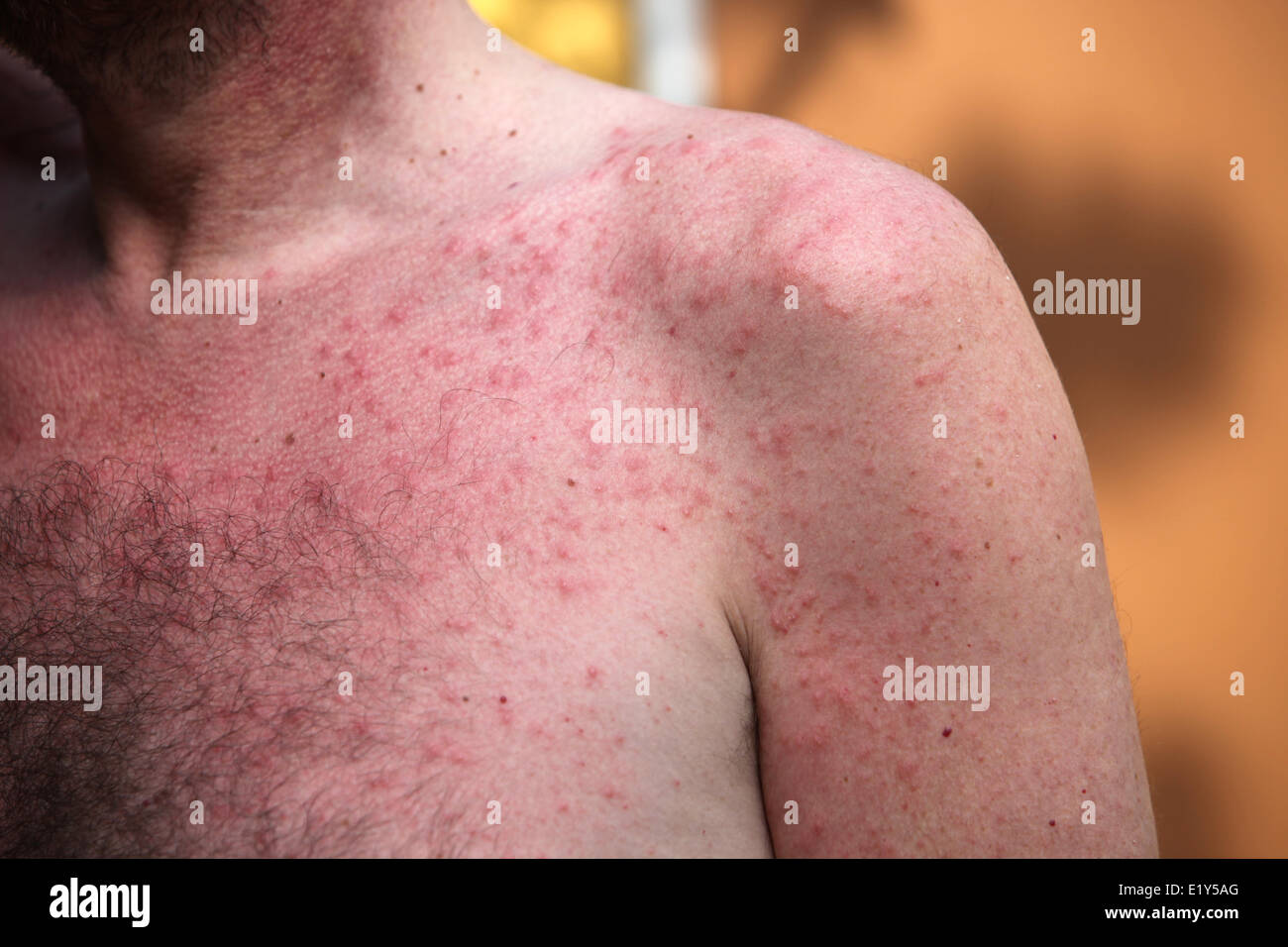 Skin rash or sun allergy Stock Photo
