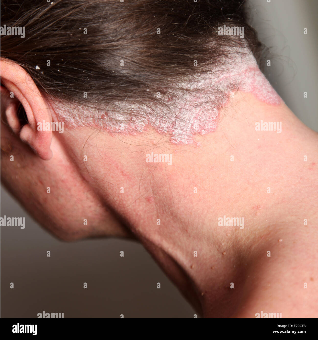 Psoriasis And Neck High Resolution Stock Photography And Images Alamy