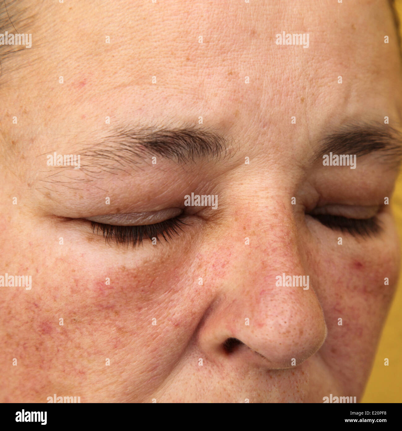 Swollen eyes and face for allergy Stock Photo