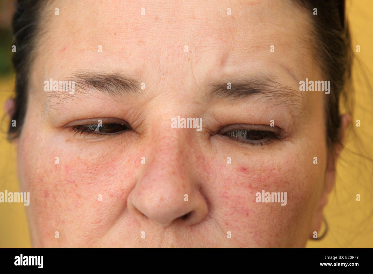 Allergy or conjunctivitis - close-up Stock Photo