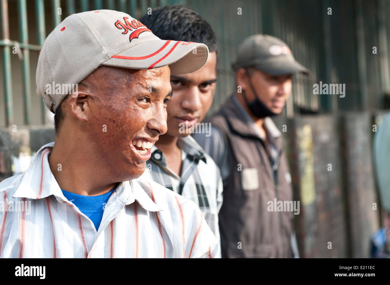 Face of badly burned man smiling in Kathmandu, Nepal Stock Photo