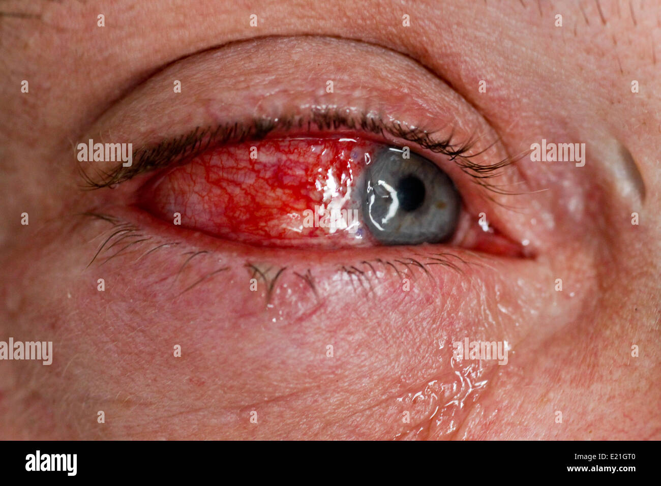 eye injury Stock Photo