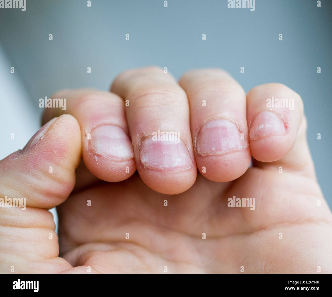 Bitten nails hires stock photography and images Alamy