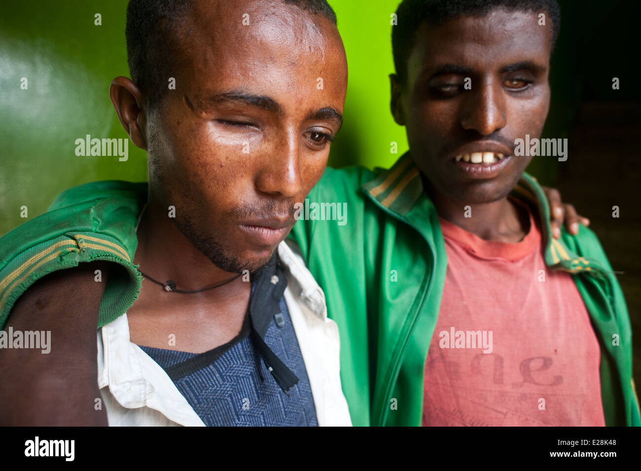 One visually impaired and one blind man suffering from trachoma ( Ethiopia) Stock Photo