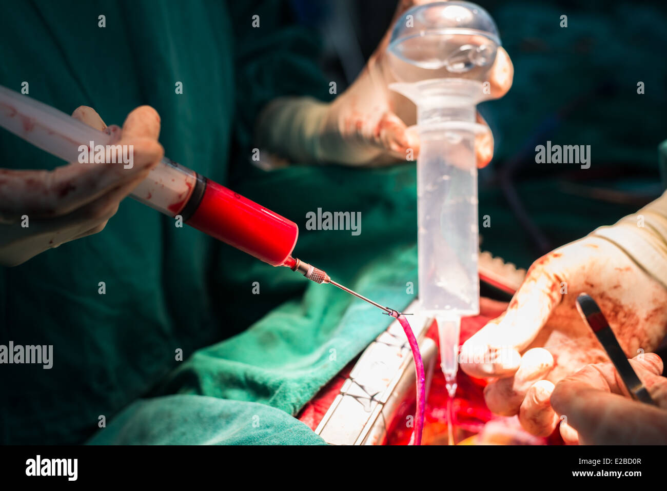 Check anastomosis by injected blood cardioplegia Stock Photo