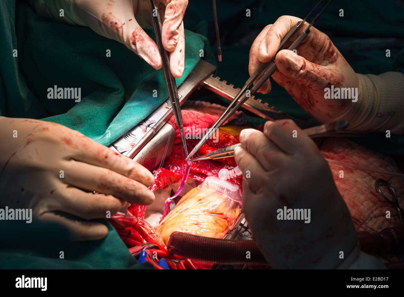 Suture greater saphenous vein conduit to diagonal artery anastomosis Stock Photo