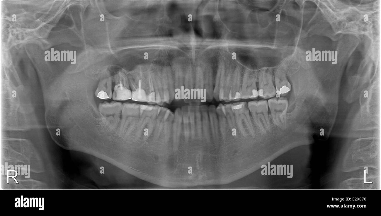Xray shoot of human mouth with dental fillings Stock Photo Alamy