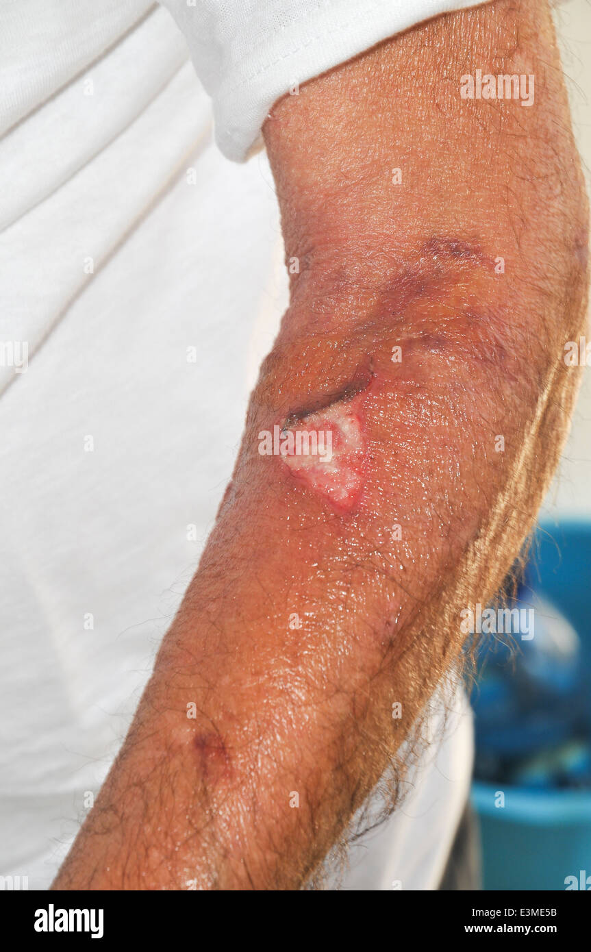 Infected wound hires stock photography and images Alamy