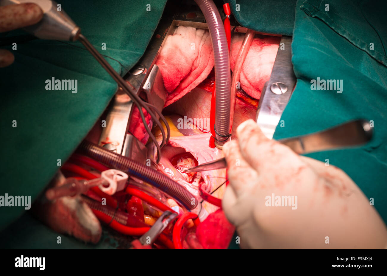 Close ventricular septal defect via tricuspid valve Stock Photo