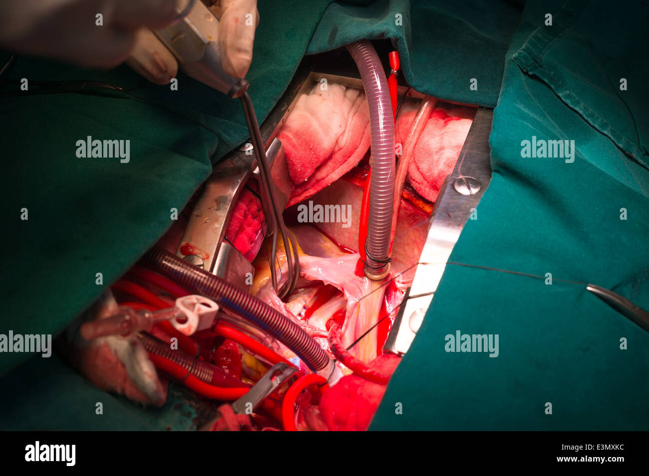 Close ventricular septal defect via tricuspid valve Stock Photo