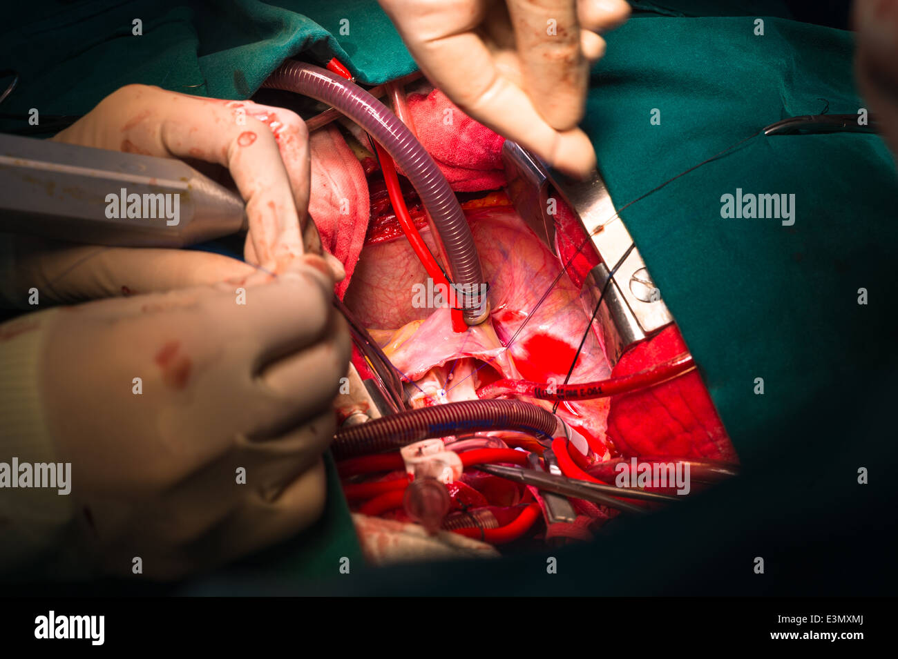 Close ventricular septal defect via tricuspid valve Stock Photo