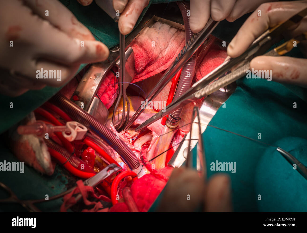 Close ventricular septal defect via tricuspid valve Stock Photo