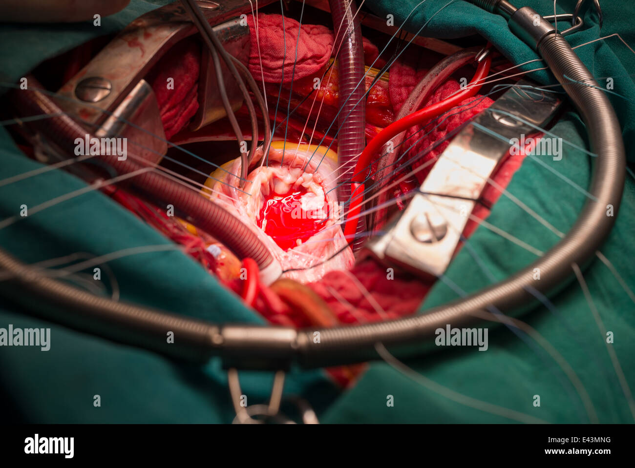 Repair tricuspid valve Stock Photo