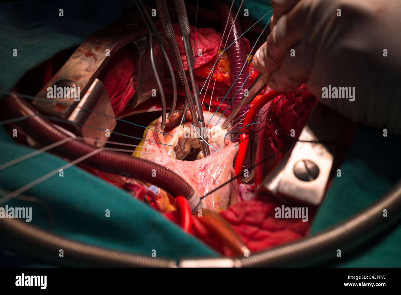 Repair tricuspid valve Stock Photo