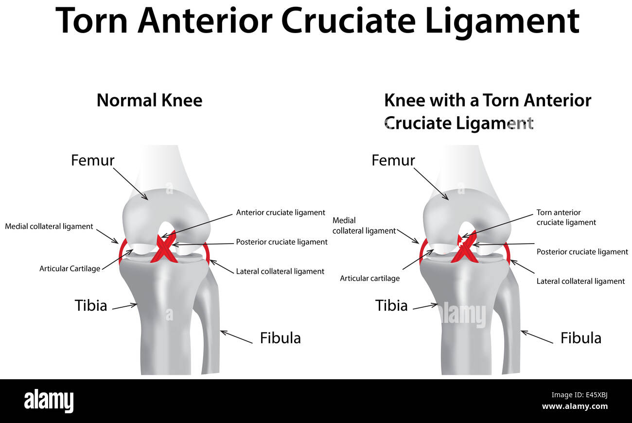 Torn anterior cruciate ligament hires stock photography and images Alamy