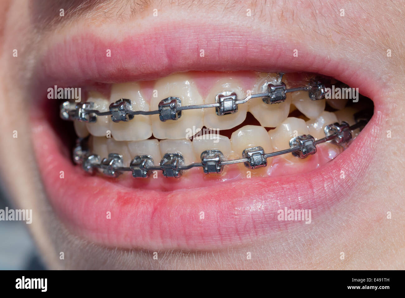 Mouth with bracket Stock Photo Alamy